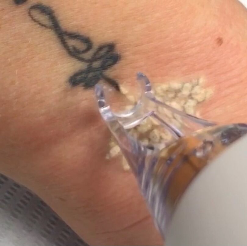 Huidkliniek COSMED tatoeage tattoo verwijderen laseren
