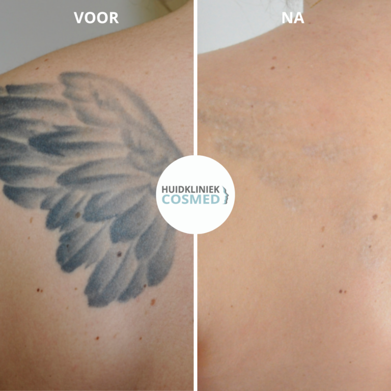 Huidkliniek COSMED tattoo verwijderen voor en na lasertherapie